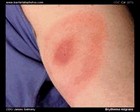 erythema migrans image